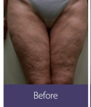 Body Sculpting and Fat Removal (vShape Ultra) Before and After Pictures Minneapolis, MN