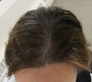 Hair Restoration Before and After Pictures Minneapolis, MN
