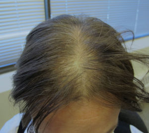 Hair Restoration Before and After Pictures Minneapolis, MN