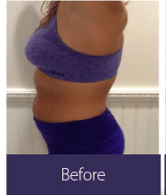 Body Sculpting and Fat Removal (vShape Ultra) Before and After Pictures Minneapolis, MN
